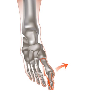 Baş parmağın Valgus deformasyonu. Ayaktaki kemikler ya da ayaktaki şişlikler, gut. Baş parmağın ilk olarak dışa doğru kayması. Eklemlerin ve kemiklerin anatomisi. Vektör illüstrasyonu