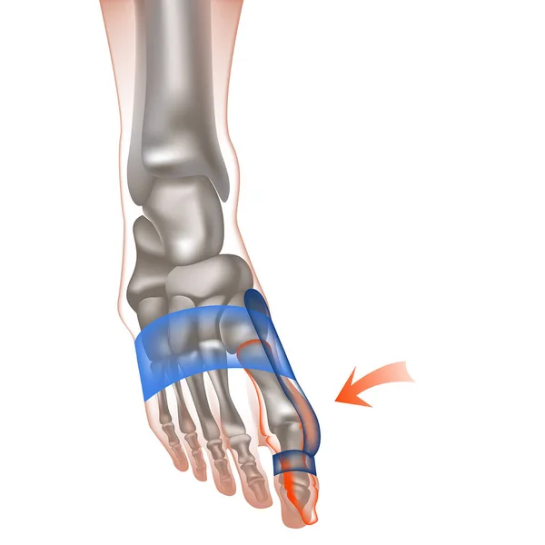 Hallux Valgus Human Foot Protruding Thumb Bones Bus Fix Problem — Stock Vector