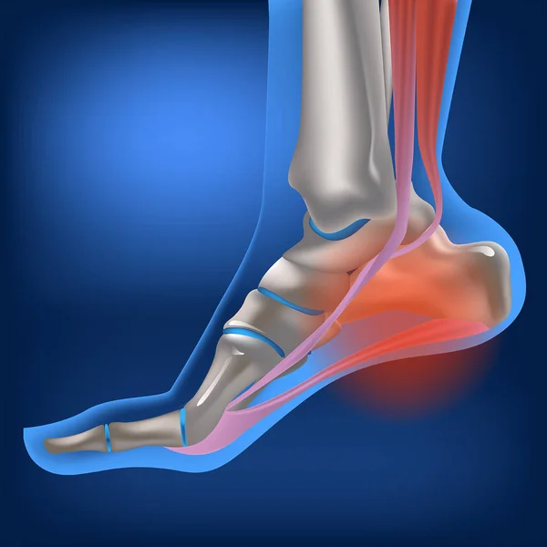 扁桃体筋膜炎 扁桃体筋膜炎 足底筋膜的炎症和变性变化 走路时疼痛 人体足部屈曲位的矢量三维绘制 — 图库矢量图片