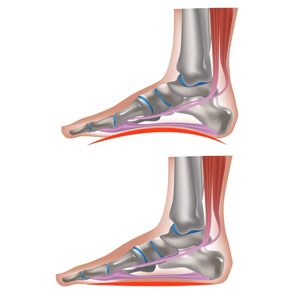 Flat Feet Deformation Longitudinal Parallel Arches Feet Overweight Strong Stress — Stock Vector