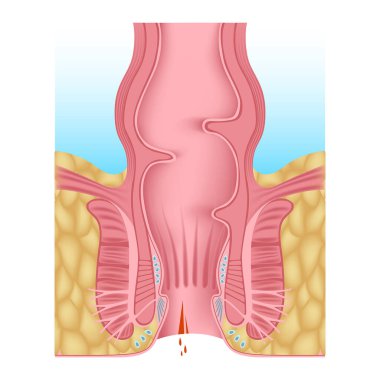 Anal çatlak. Anal açıklığın hemoroidi. Sindirim sistemi anatomisi. Tıbbi dosya. Hemoroidal pleksus. Vektör illüstrasyonu