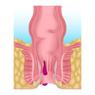 Internal and external hemorrhoids. Hemoroid plexus. Inflammation of the anus. Digestive organs anatomy. Medical poster. Vector illustration
