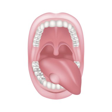 Swelling in the tongue. Wide open mouth. Upper and lower jaw with teeth. Disease of the oral cavity. Medical illustration. clipart