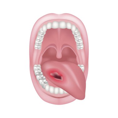 Dil kanseri, ağız boşluğu. Yara ağızda. Onkoloji. Çene anatomisi. Vektör illüstrasyonu