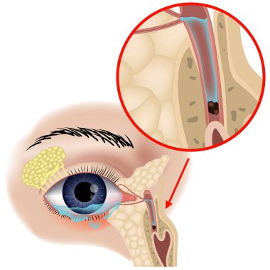 Blockage of the lacrimal canals. Dacryocystitis. Anatomy of the eye. The structure of the ducts. Lachrymation. Medical training poster. Vector illustration. clipart