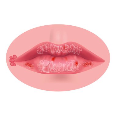General cheilitis. Inflammation of the lips. Cracked mucous membrane. Vector illustration clipart