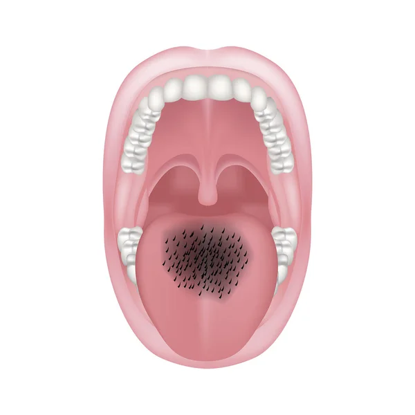 Glossite Tüyleri Dildeki Papillae Büyümesi Kalıcı Travma Kandiyoz Ile Tıbbi — Stok Vektör