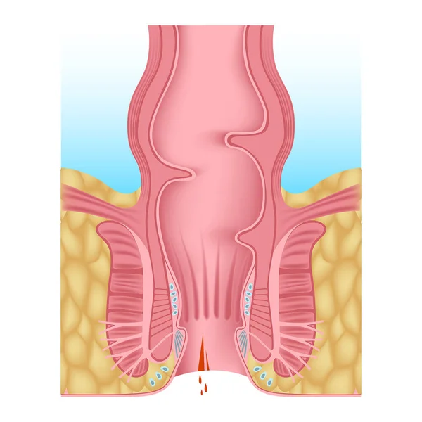 Anal Fissure Hemorrhoids Anal Opening Digestive System Anatomy Medical Chart — Stock Vector