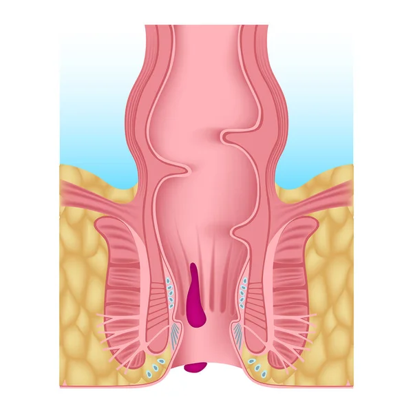 Internal External Hemorrhoids Hemoroid Plexus Inflammation Anus Digestive Organs Anatomy —  Vetores de Stock