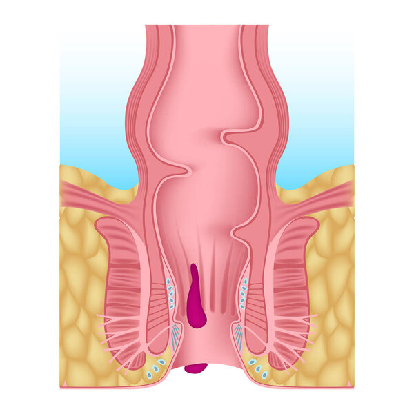 Internal and external hemorrhoids. Hemoroid plexus. Inflammation of the anus. Digestive organs anatomy. Medical poster. Vector illustration