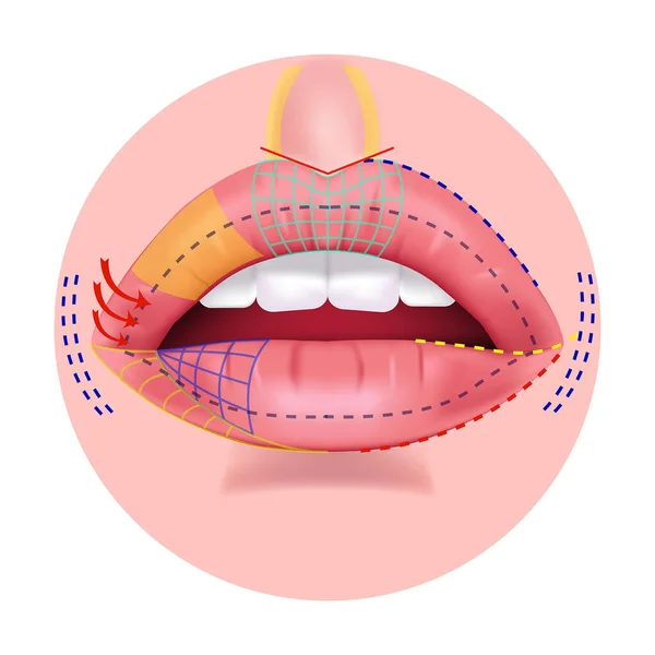 Anatomie Des Lèvres Diviser Zones Séparées Cosmétologie Chirurgie Plastique Illustration — Image vectorielle