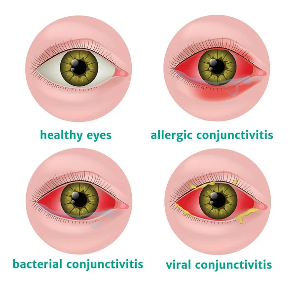 Conjuntivite Doenças Olho Humano Vírus Bacteriano Alérgico Auxiliar Ensino Oftalmologista —  Vetores de Stock