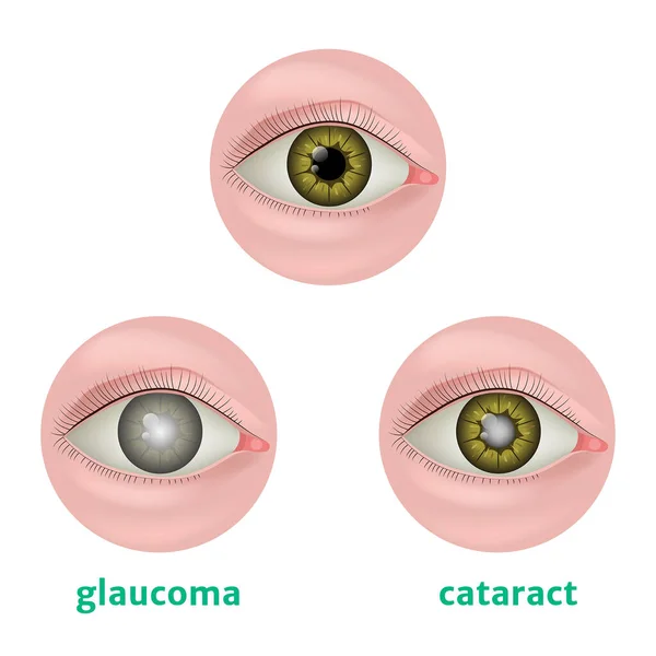 Kornea Lökoması Belmo Göz Hasarı Göz Morarması Görme Organlarının Hastalıkları — Stok Vektör