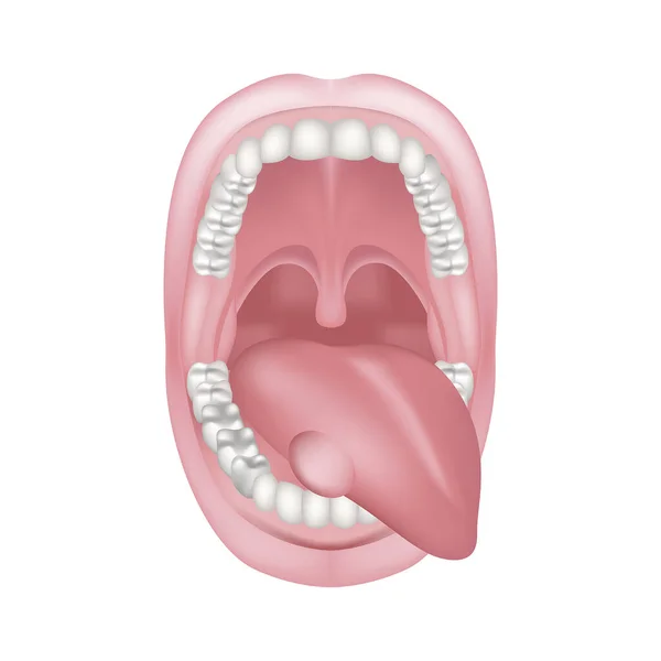 Набряк Язиці Широкий Відкритий Рот Верхня Нижня Щелепа Зубами Захворювання — стоковий вектор