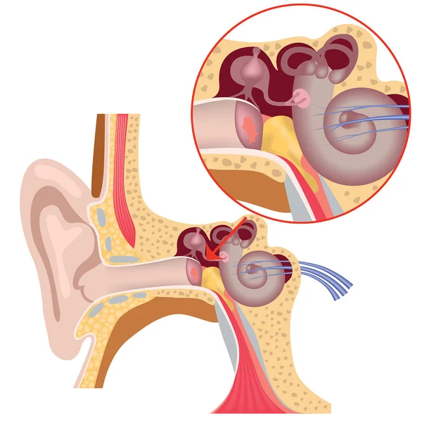 Anatomía Del Oído Interno Daño Membrana Timpánica Acumulación Pus Ilustración — Archivo Imágenes Vectoriales