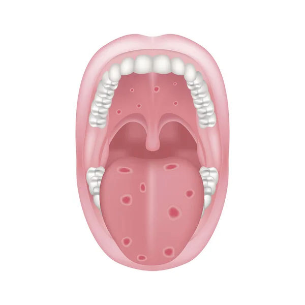 口頭試問 一般的な病気 舌と口蓋の潰瘍 ベクターイラスト — ストックベクタ