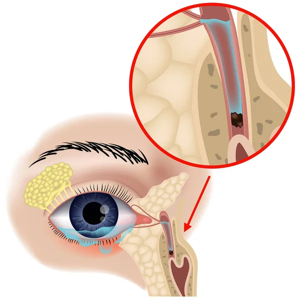 運河の閉塞 ダクリオシスチス 眼の解剖学 ダクトの構造 ラカリム化だ 医療訓練ポスター ベクターイラスト — ストックベクタ