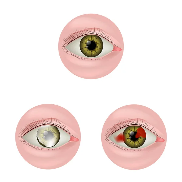 Corneal Leukoma Belmo Eye Damage Eyeball Bruising Diseases Organs Vision — Stock Vector
