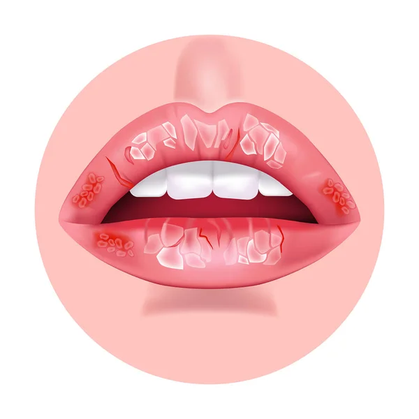 Chronic Cheilitis Dry Chapped Lips Ripped Skin Disease Mouth Flaking — Stock Vector