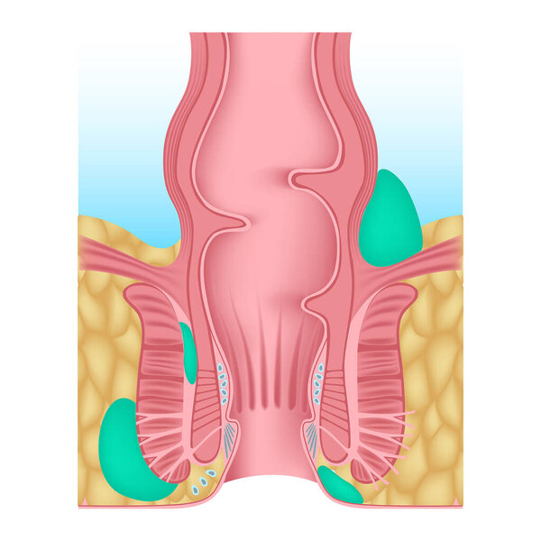 Anorectal abscess. Swelling near the anus. Inflammation of the anus and rectum. Disease of the glands. Accumulation of pus. Anatomy diagram of the anus. Vector illustration