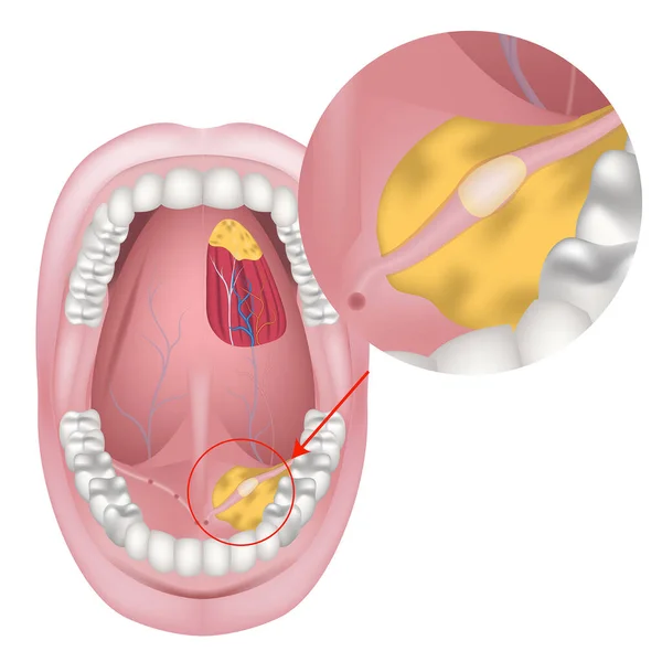 Tükürük Bezlerinin Kanallarında Taş Var Neoplazma Gösteren Diyagram Ağzın Zeminine — Stok Vektör