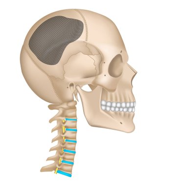 Kafatasında kraniyoplasti. Kafadaki kemikleri onarma operasyonu. Metal ağ, tabak. İnsan anatomisi. Servikal omurga Vektörü çizimi.