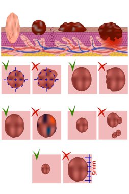 Benin ve melanomun anatomik yapısı. Deri kanseri önleme testi. Vektör illüstrasyonu