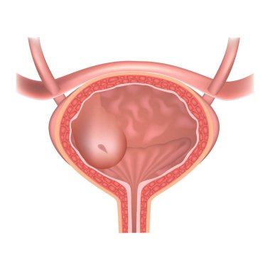 Ureterosel. İnsan üreme sisteminin yapısını da. Vesiküler bölme. İdrar kesesinde fıtık. Vektör illüstrasyonu.