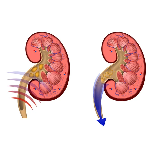 超音波による腎臓結石の除去 小さな断片に粉砕 尿路系 ベクターイラスト — ストックベクタ
