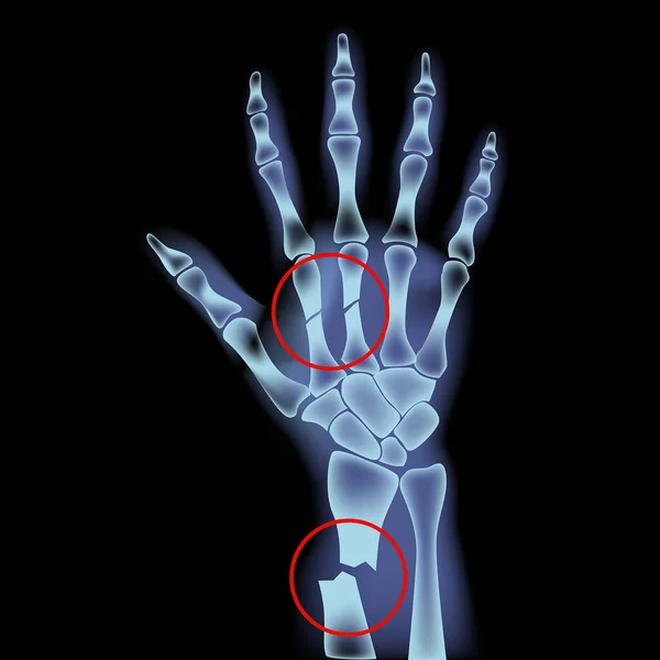 Fraktur Metakarpal Och Radiusbenen Röntgen Mans Hand Vektorillustration — Stock vektor