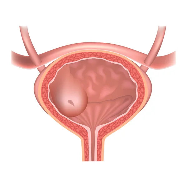 Ureterocele Struttura Del Sistema Genito Urinario Umano Compartimento Vescicolare Ernia — Vettoriale Stock