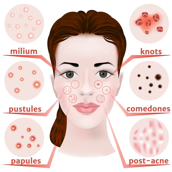 脸上的痤疮 皮肤病的类型 黑点腺体不能正常工作 粉刺和粉刺 矢量说明 — 图库矢量图片