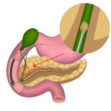 Safra kesesi kanallarından endoskopik safra taşı alınması. Pankreas. Sindirim organları anatomisi. Mideden ameliyat. Vektör tıbbi illüstrasyon