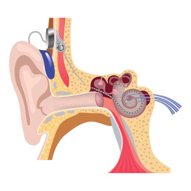 Koklear implantasyon sistemi. İç kulak ameliyatına cevap ver. Elektron dizisi. Vektör illüstrasyonu