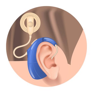 Koklear implant. Kulağında işitme cihazı var. Duyusal işitme kaybı. Sağırlık tedavisi. İşitsel sinir için protez. Duyma kaybı tazminatı. Vektör illüstrasyonu