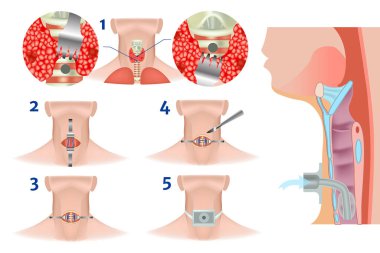 Upper and lower tracheostomy. Tracheal surgery. Execution scheme. A scalpel incision. Airway obstruction. Plastic cannula with inflatable cuff.ead thrown back. Medical vector illustration clipart