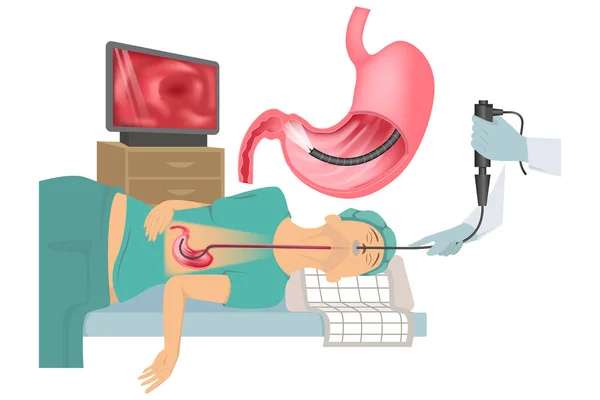 睡眠胃鏡検査 口腔内に挿入胃の内視鏡付きの医療ベッドの上の患者 医療ポスター ベクターイラスト — ストックベクタ