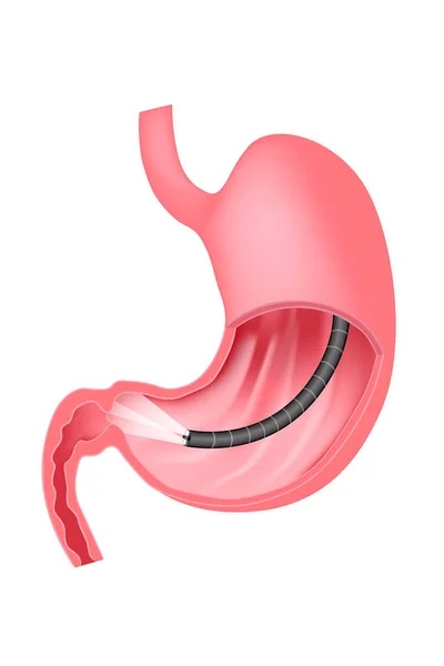 Gastroscopia Examen Endoscópico Del Estómago Membrana Mucosa Del Tracto Digestivo — Vector de stock