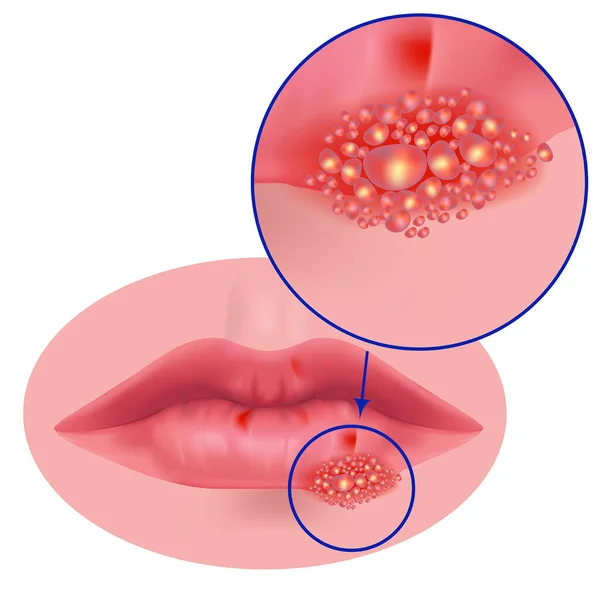 Έρπης Στα Χείλη Από Κοντά Διάνυσμα Ιατρική Απεικόνιση — Διανυσματικό Αρχείο