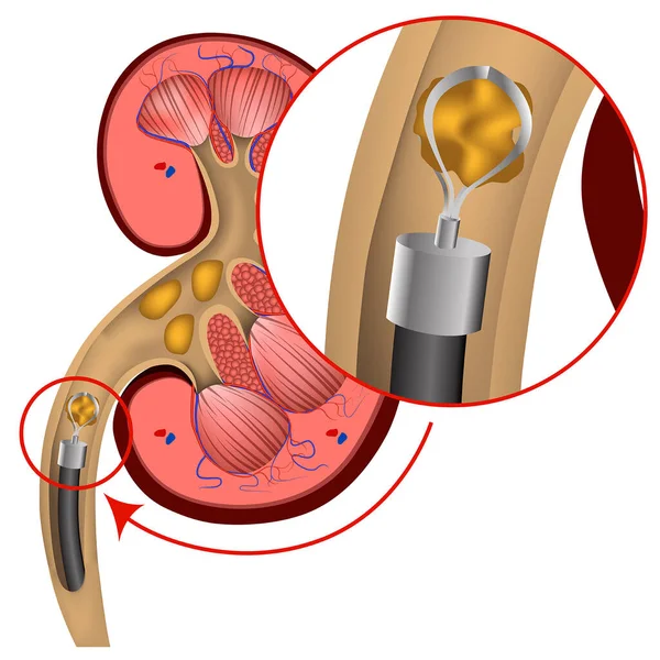 腎臓結石の内視鏡的除去 ベクトル医療イラスト — ストックベクタ