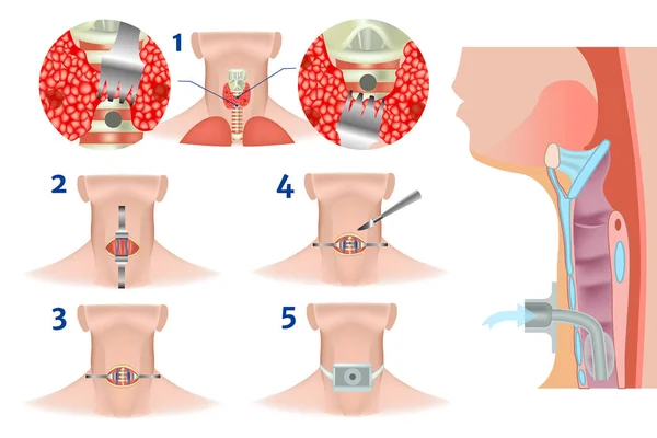 Trachéostomie Supérieure Inférieure Chirurgie Trachéale Régime Exécution Une Incision Scalpel — Image vectorielle