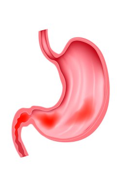gastroduodenitis. Inflammation of the mucous membranes of the stomach and duodenum. clipart