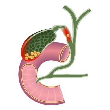 Safra kesesi kanseri. Pankreasın dışkı borusu. Duodenum. Vektör illüstrasyonu.