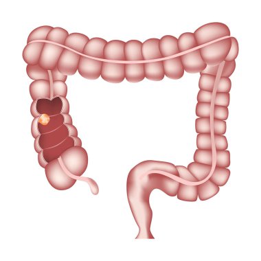 Bağırsak kanseri. İç organ anatomisi. Tümör. Vektör illüstrasyonu.
