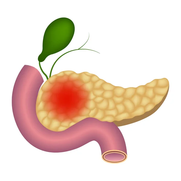 Inflamación Del Páncreas Humano Duodeno Vesícula Biliar Ilustración Vectorial — Vector de stock
