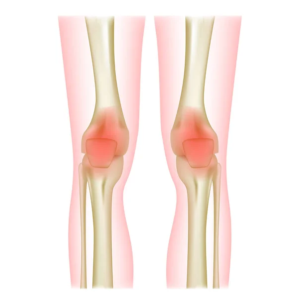 Kniegelenke Menschliche Beinknochen Vektorillustration — Stockvektor