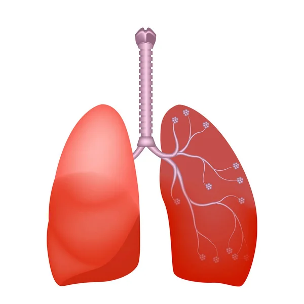 Anatomía Pulmonar Humana Absceso Pulmonar Propagación Infección Desde Abajo Ilustración — Vector de stock