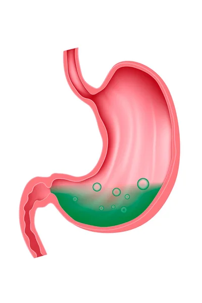 Estómago Lleno Jugo Gástrico Verde Mayor Acidez Helicobacter Pylori Ilustración — Vector de stock