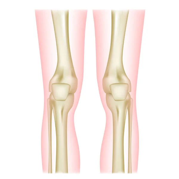 Wunde Knie Schmerzhafte Gelenke Die Struktur Menschlicher Knochen Vektorillustration — Stockvektor