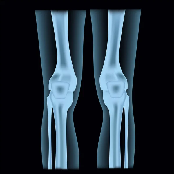 Röntgende Insan Bacakları Diz Eklemleri Skelet Yapısı Vektör Illüstrasyonu — Stok Vektör